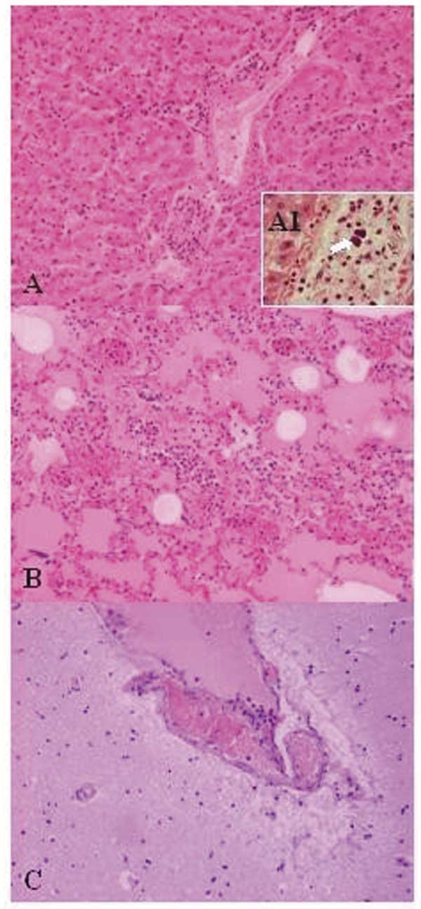 Lesions in the mona monkey (hematoxylin and eosin stain): A) liver: portal triads with neutrophilic infiltration (x10); A1, presence of bacterial emboli inside the vein (arrow) (x40). B) acute pneumonia: edema, congestion, and leukocyte cells exudation in the pulmonary alveoli (x10). C) encephalitis: congestion and marginalized neutrophils in nervous vessels (x10).