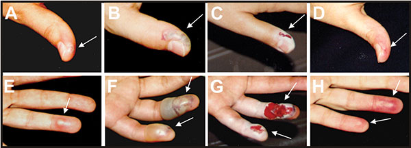 Progression of the local reaction on the left hand after accidental needlestick inoculation with vaccinia virus: thumb (A, day 4; B, day 11; C, day 12; D, day 20; fourth and fifth fingers (E, day 7, F, day 11; G, day 12; H, day 20). Lesions were surgically excised to remove necrotic tissue on day 11. Arrows indicate the lesion areas.