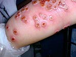 Thumbnail of Cowpox lesions on patient’s forearm on day 7 after onset of illness.