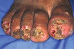 Thumbnail of Right foot of a 50-year-old man. All nails have been lost. Embedded fleas have been manipulated by the patient, leaving innumerable sores. Desquamation and ulceration are merged. The skin tends to bleed where the stratum corneum is eroded.