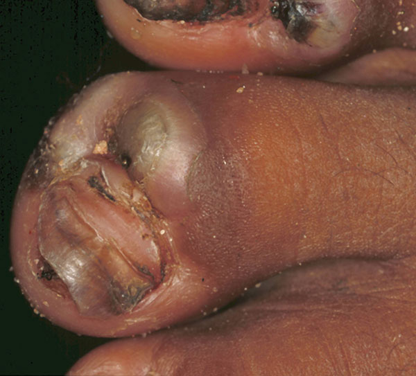 Fourth toe of a 50-year-old women. The nail is lifted up by a lesion. An abcess has formed near the nail wall, and the toe is distorted because of intense edema.