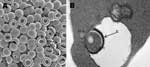 Thumbnail of A) Electron microscopy scan of peripheral blood. B) Transmission electron microscopy scan of peripheral blood. a, membrane invaginations; b, stomatocytes and spherostomatocytes; c, erythrocyte with vacuole-enclosed suspect organism.