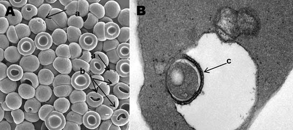 A) Electron microscopy scan of peripheral blood. B) Transmission electron microscopy scan of peripheral blood. a, membrane invaginations; b, stomatocytes and spherostomatocytes; c, erythrocyte with vacuole-enclosed suspect organism.