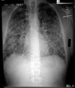 Thumbnail of Chest radiograph of patient who acquired acute pulmonary histoplasmosis after visiting a cave in Nicaragua.