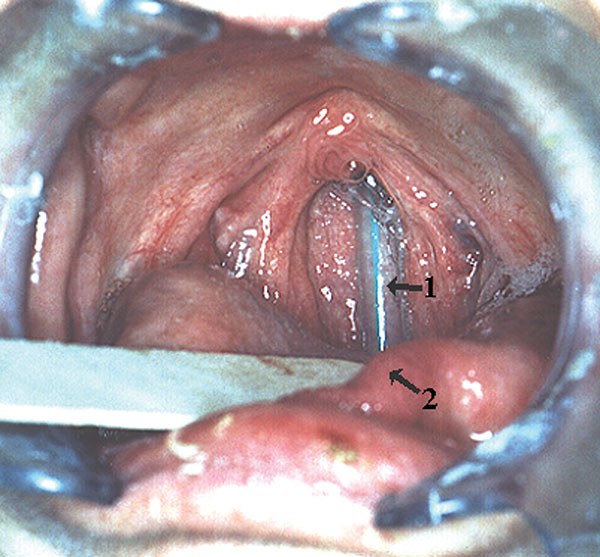 Nasogastric tube embedded in the nasopharynx. 1, nasogastric tube; 2, dorsum of tongue.