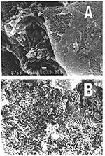 Thumbnail of Representative biofilms on nasogastric tubes showing bacterial organisms with typical form of Pseudomonas aeruginosa. Scanning electronic microscope. A, scale bar, 1 µm; B, scale bar, 10 µm.