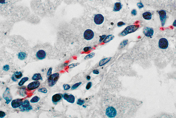 Immunohistochemical stain demonstrates Rickettsia rickettsii in endothelial cells of a blood vessel in kidney from patient l. (Hematoxylin counterstain; original magnification X 1200).