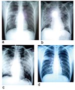 Thumbnail of Chest radiographs of two patients with severe acute respiratory syndrome (SARS). a–c: radiographs of patient 5 showing progression of changes. a, day 8 of symptoms; b, day 13 of symptoms, d, day 14 of symptoms. He died on day 19 of this illness. d, chest radiograph, taken on day 8 of symptoms, of patient 12, with right upper lobe infiltrates resembling pulmonary tuberculosis (TB) but laryngeal swab cultures for TB were negative.
