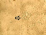 Thumbnail of Early cytopathic effect of human metapneumovirus in rhesus monkey kidney (LLC-MK2) cell monolayers. A focus of infected cells that exhibit refractile rounding is indicated by an arrow (100X).