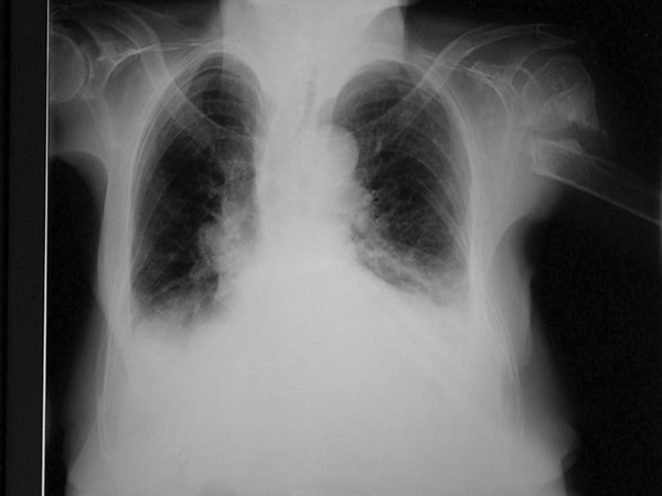 Chest radiograph at first admission.