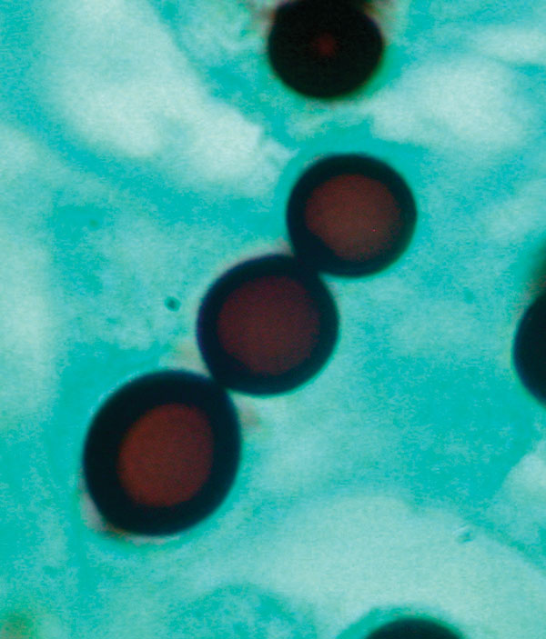 Grocott methenamine silver–stained section of skin biopsy specimen revealing a short chain of lemon-shaped fungal cells connected by thin, tubelike bridges. Morphology is consistent with the appearance of Loboa loboi. Magnification x1,000.