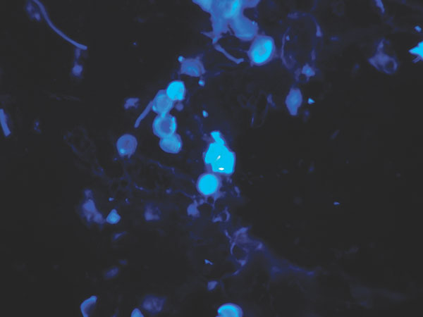 Calcofluor white stain of skin biopsy specimen. A short chain of lemon-shaped fungal cells is seen in the left-center of the field. Cells are connected to each other by thin, tubelike structures. Magnification x400.