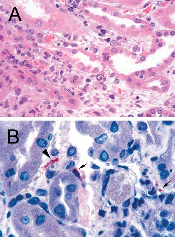 A: Renal biopsy shows inflammatory cell infiltrate in the interstitium and focal denudation of tubular epithelial cells. Hematoxylin and Eosin; original magnifications x100. B: Immunostaining of fragmented leptospire (arrowhead) and granular form of bacterial antigens (arrows). Original magnifications x158.
