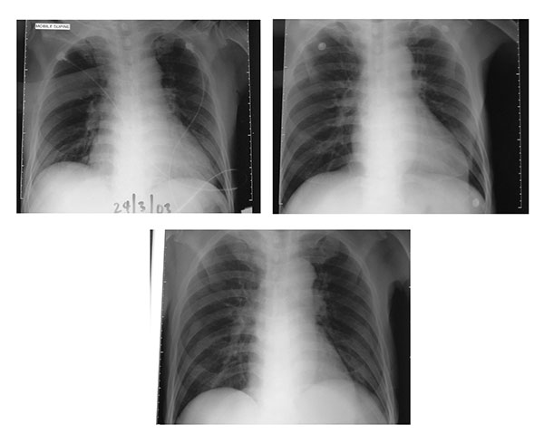 A, radiograph on admission; B, radiograph on day 5 of hospital stay; C, radiograph on day 7 of hospital stay.