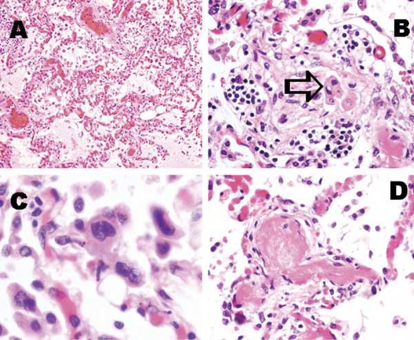 Pathologic findings of lung tissue sections. A: Pulmonary congestion and edema (H&amp;E stain, original magnification x100). B: A mild degree of interstitial lymphocytic infiltration. Intra-alveolar organizing exudative lesion was occasionally found. Detached atypical pneumocytes indicated by arrow (H&amp;E stain, original magnification x200). C: Atypical multinucleated pneumocytes were occasionally identified. Definite viral inclusion was not apparent (H&amp;E stain, original magnification x400