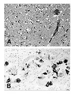 Thumbnail of Tissue lesions from a harbor seal (Phoca vitulina) with phocine distemper virus infection. (A) Cerebral cortex with nonsuppurative encephalitis. Hematoxylin and eosin staining. (B) Immunohistochemical labeling of morbilliviral antigen in glandular epithelial cells of the lung. Avidin-biotin-peroxidase technique with Papanicolaou’s hematoxylin counterstain.