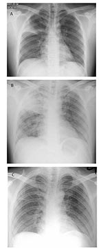 Thumbnail of Chest radiographs performed A, at admission, B, on day 4, and C, on day 16 of hospitalization for index SARS case-patient, Prince of Wales Hospital.