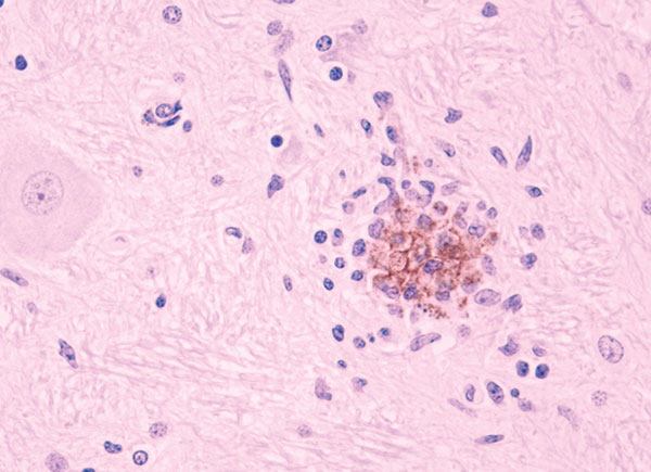 Staining of West Nile virus antigen in a glial nodule in the brainstem. Immunohistochemistry. 20x.