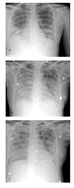 Thumbnail of Chest radiographs of case-patient with severe acute respiratory syndrome (SARS) while pregnant. a, day 6 of illness; b, day 10; c, day 13.