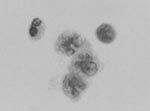 Thumbnail of Three Mollaret-like cells are present (center), with a neutrophil (upper left) and a lymphocyte (upper right) in cerebrospinal fluid from a patient with West Nile Virus encephalitis, confirmed by reverse transcription–polymerase chain reaction and serologic testing (Papanicolaou stain; magnification x 500).