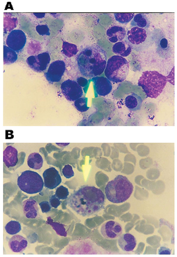 Bone marrow aspiration smear, stained with Wright, showing hemophagocytosis. A) shows phagocytosis of an erythrocyte and nuclear remnants by macrophance. B) shows phagocytosis of platelets by a macrophage.