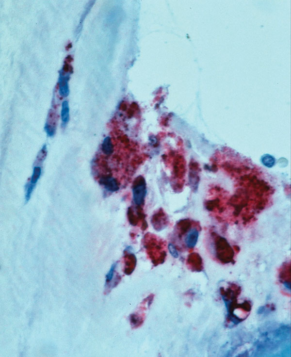 Immunohistochemical localization of Coxiella burnetii antigens in the aortic valve of a patient co-infected with HIV. Intact bacteria and fragment antigens are identified predominantly within macrophages in the fibrosed and calcified valve tissue. (Immunoalkaline phosphatase stain with naphthol phosphate fast-red substrate and hematoxylin counterstain, original magnification X100).
