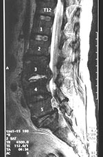 Thumbnail of Magnetic resonance imaging scan of spine showing features compatible with discitis involving L3/L4 with surrounding paravertebral and psoas inflammation and epidural abscess.