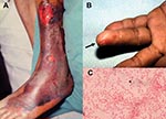 Thumbnail of Characteristic skin lesions of Vibrio vulnificus infection and morphotype of the microorganism. (A) Gangrenous change with hemorrhagic bullae over the leg in a 75-year-old patient with liver cirrhosis in whom septic shock and V. vulnificus bacteremia developed. (B) V. vulnificus bacteremia developed 1 day after a fish bone injury over the 4th finger of the left hand (arrow) in a 45-year-old patient with uremia. (C) Gram-negative curved bacilli (arrowhead) isolated from a blood sampl