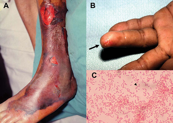 Characteristic skin lesions of Vibrio vulnificus infection and morphotype of the microorganism. (A) Gangrenous change with hemorrhagic bullae over the leg in a 75-year-old patient with liver cirrhosis in whom septic shock and V. vulnificus bacteremia developed. (B) V. vulnificus bacteremia developed 1 day after a fish bone injury over the 4th finger of the left hand (arrow) in a 45-year-old patient with uremia. (C) Gram-negative curved bacilli (arrowhead) isolated from a blood sample of the 45-y