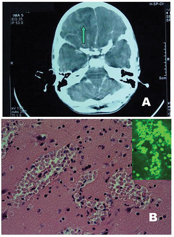 A) Computed tomographic scan: note the right fronto-basal collection (arrow) with a midline shift right to left. B) Brain histology: three large clusters of amebic vegetative forms are seen (H-E stain, x 250). Inset: Positive indirect immunofluorescent analysis on tissue section with anti– Naegleria fowleri serum.