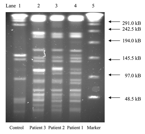 Pulsed-field gel electrophoresis patterns using restriction enzyme AseI, of Mycobacterium goodii isolates from three patients with postoperative wound infections after receiving surgical implants from a hospital in Colorado. Lane 1 is control strain M. goodii ATCC 700504. Lanes 2–4 are case-isolates. Lane 5 is a 48.5-kb DNA marker.