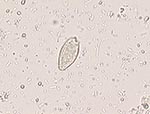 Thumbnail of Opisthorchis-Clonorchis egg detected in the stool of one patient.