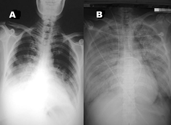 A. Chest radiograph on hospital day 5 at referring hospital shows patchy infiltration at bilateral lower lung fields. B. Chest radiograph upon admission to our hospital (24 hours later) shows rapidly progressive pneumonia in both lung fields, compatible with adult respiratory distress syndrome.
