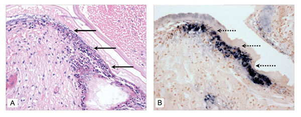 Histologic section through the anterior gastric chamber of a moribund juvenile Litopenaeus vannamei that was injected with an inoculum prepared with tissue cell culture media from BGMK cells exposed to Taura syndrome virus (TSV) (day 7 postexposure). A) The arrows point to a portion of cuticular epithelium displaying diagnostic acute-phase TSV lesions (hematoxylin/eosin-phloxin stain; 50x). B) The dashed arrows point to a portion of the stomach epithelium from the same shrimp, where digoxigenin