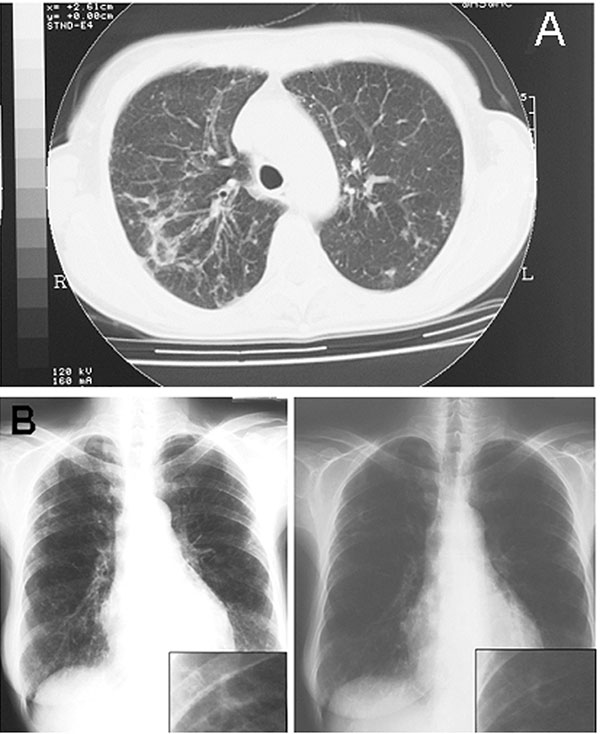 A) Pulmonary computed tomographic scan representation of Mycobacterium lentiflavum lesions. Radiologic image shows the appearance of a widespread reticulonodular alteration and an opacity in the left middle lobe. B) Chest radiograph evolution after 3 months of treatment shows a sustained improvement of the radiologic alterations to the left pulmonary middle lobe.