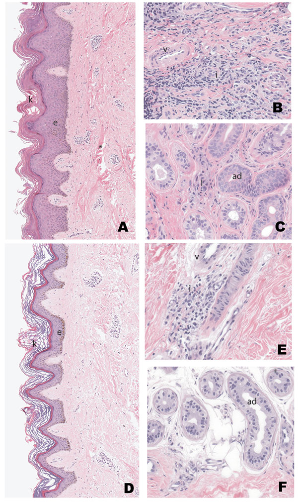 Representative sample of skin punch biopsy specimens from patients with lymphedema before (A, B, C) and after (D, E, F) 1 year of basic lymphedema management. Pretreatment abnormalities of the epidermis (e), which include increased number of epithelial cells (acanthosis and epidermal hyperplasia) and thickening of the keratin (k) layer, were improved after treatment (compare first [A] and second [D] biopsies from same patient). Also noted is thickening of collagen bundles (*) in the dermis on th