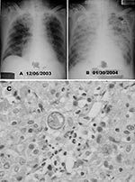 Thumbnail of A) Chest radiograph shows diffuse nodular lesions in both lungs. B) Chest radiographic scan taken 2 months later shows coalescence of nodular shadows and almost complete white-out of bilateral lung fields. C) Hematoxylin and eosin staining of the wound specimen from pleural biopsy site showed spherules of Coccidioides immitis and chronic necrotizing granulomatous inflammation (400x).