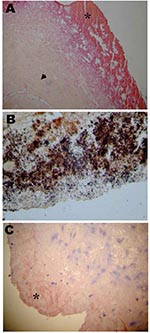 Thumbnail of A) Section of an aortic valve from a patient with Bartonella endocarditis. Note the extensive fibrosis of the connective valve tissue (arrowhead), the vegetation (*), and the low inflammatory infiltrate of the valve tissue (hematoxylin-phloxine-saffron, original magnification 100x). B) Resected valve with Bartonella quintana infection showing darkly stained bacilli consistent with Bartonella. Note the numerous clusters of argyrophilic bacteria present in the valvular vegetation (War