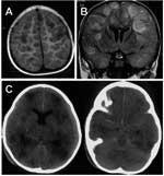Thumbnail of Axial T1-weighted magnetic resonance imaging (MRI) scan (A) and coronal fluid attenuated inversion recovery (FLAIR) (B) show multifocal, mainly cortical and subcortical lesions of high signal intensity, which are most probably caused by multifocal encephalitis. C) Nonenhanced axial computed tomographic (CT) scan performed 2 days after the MRI shows multiple, hypodense lesions and signs of general edema. Additionally, it shows a hyperdense arachnoid collection that was not yet visibl