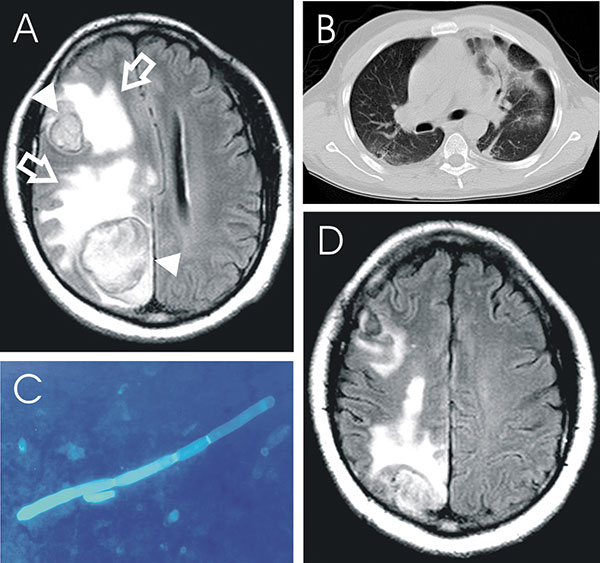 Chrysosporium sp. brain abscess in an HIV-seropositive patient. A) T2-weighted magnetic resonance imaging (MRI) scan of the brain showing 2 large masses (triangle) surrounded by a ring of signal intensity and extensive perifocal edema (open arrows), global swelling of the right hemisphere, and a midline shift of 1.2 cm. B) Computed tomographic scan of the chest showing infiltration of the left and right lower segment. C) Mold mycelium in aspirate of brain abscess using calcoflour white stain. D)