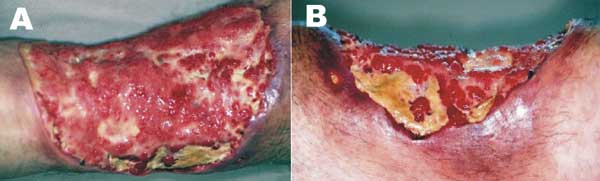 Clinical aspects of the lesion when the patient sought treatment at the University Hospital. The figure depicts the wide extension of the lesion in a frontal (A) and in depth (B) medial views.