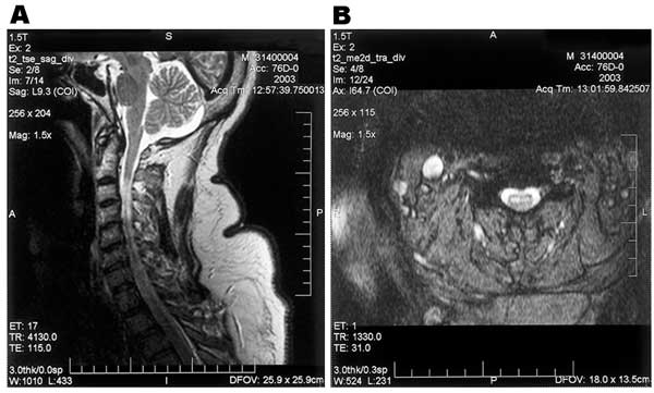 Saggital (A) and axial (B) T2-weighted magnetic resonance images of the cervical spinal cord in a patient with acute asymmetric upper extremity weakness and subjective dyspnea. A shows a diffuse cervical cord signal abnormality, and B shows an abnormal signal in the anterior horn region.