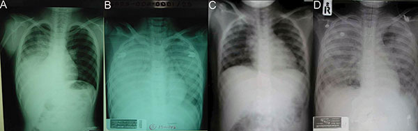 Chest radiographs from patients 8 and 9. Panel A demonstrates patchy alveolar infiltration of the right lower lung on day 5 of illness for patient 9; panel B demonstrates the progression to acute respiratory disease syndrome (ARDS) on day 8. panel C shows interstitial infiltration of both lungs of patient 8 on day 4 of illness; panel D shows the rapid progression to ARDS by day 6.