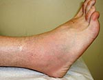 Thumbnail of Patient 1: ankle swelling, pain, tenderness, erythema, and warmth on day 10 of illness.