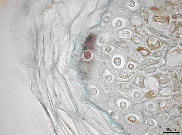 Immunohistochemical stain of neck biopsy specimen. Note the positive cell in the center with small intracytoplasmic granules at the border of stratum granulosum and stratum corneum of the epidermis. On the right side, melanin-rich epidermal cells are seen. Bar = 10 μm.