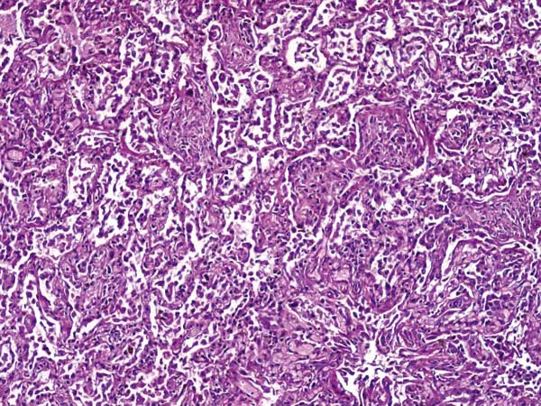 Microscopic shape of the lung showing proliferative phase of diffuse alveolar damage and interstitial pneumonia with reactive hyperplasia of pneumocytes (magnification x100).