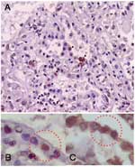 Thumbnail of Immunohistochemical analysis showing influenza A antigen-specific staining in nuclei of cells lining the alveoli (A). To identify the cell type, slides from consecutive sections were stained with anti-influenza A antibody (B) and double-stained with antiinfluenza A and antisurfactant antibodies (C). The sections were mapped, and the same area in each section was examined. Viral antigen-positive cells were stained both intranuclearly with antiinfluenza antibody and intracytoplasmical