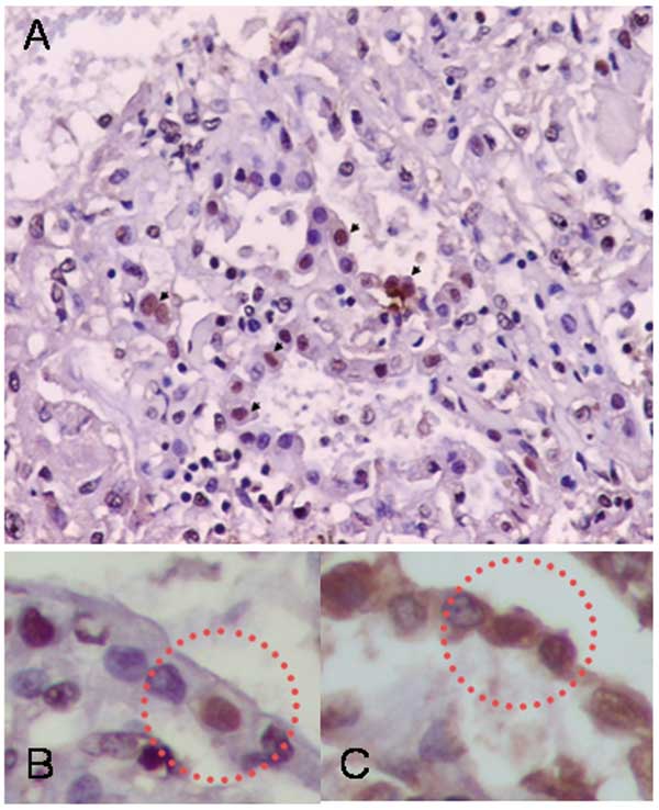 Immunohistochemical analysis showing influenza A antigen-specific staining in nuclei of cells lining the alveoli (A). To identify the cell type, slides from consecutive sections were stained with anti-influenza A antibody (B) and double-stained with antiinfluenza A and antisurfactant antibodies (C). The sections were mapped, and the same area in each section was examined. Viral antigen-positive cells were stained both intranuclearly with antiinfluenza antibody and intracytoplasmically with antis