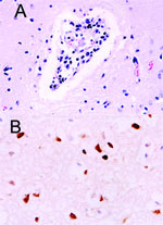 Thumbnail of Histopathologic and immunohistochemical evidence of H5N1 virus in tiger: A) Mild multifocal nonsuppurative encephalitis; B) Influenza A virus antigen in nuclei and cytoplasm visible as brown staining.