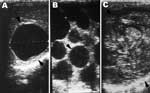 Thumbnail of Lesions of cystic echinococcosis (CE) by abdominal ultrasound examination. A) CE lesion with distinct rim. B) Typical CE lesion with daughter cysts. C) Calcified CE lesion after chemotherapy.
